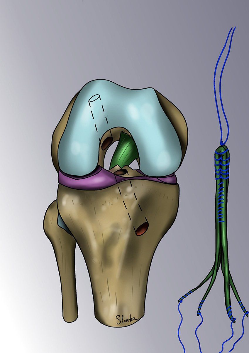 Illustration du DIDT+LCA2+transplant