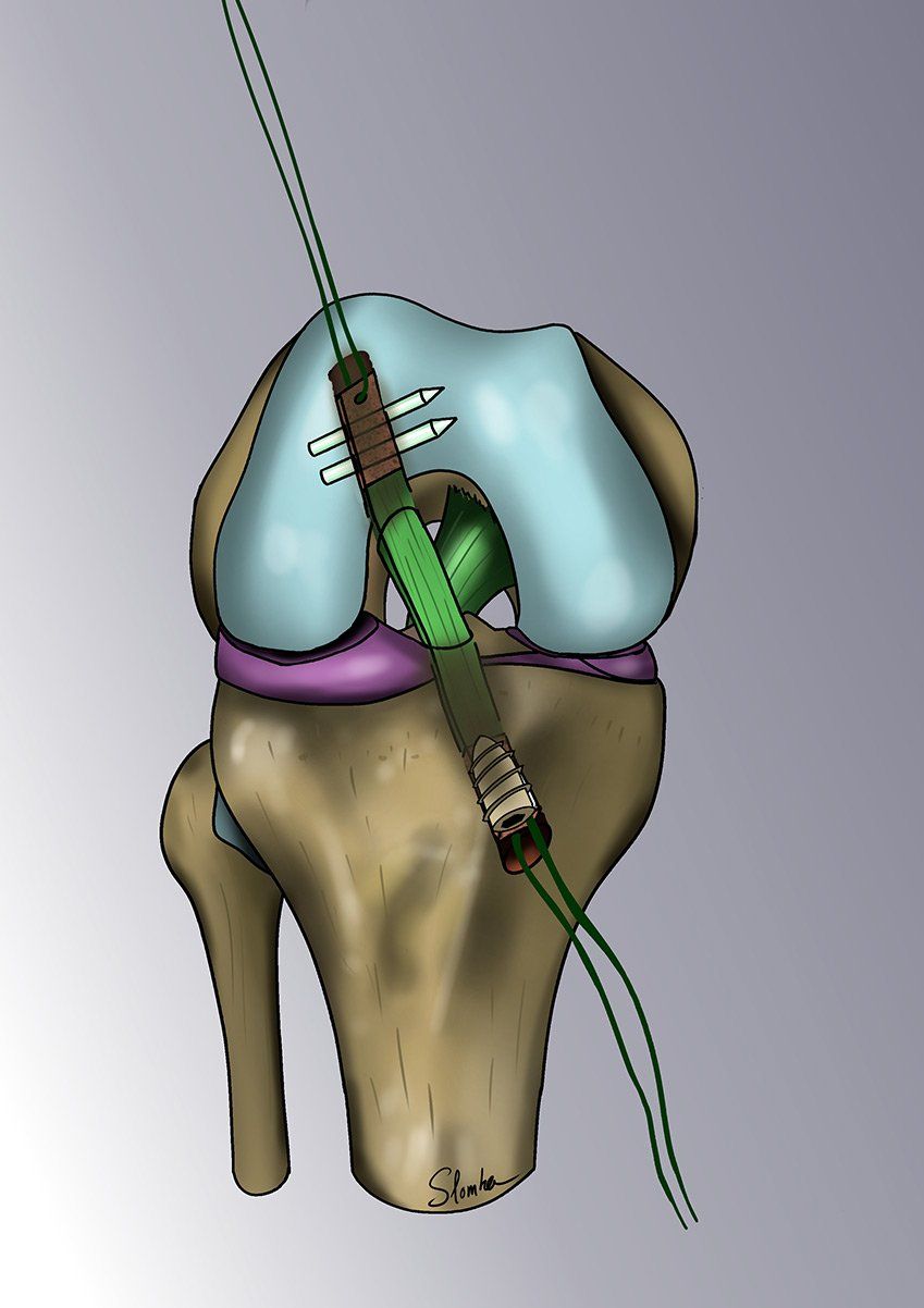 Illustration d'une OPÉRATION DU LIGAMENT CROISÉ ANTÉRIEUR étape 3
