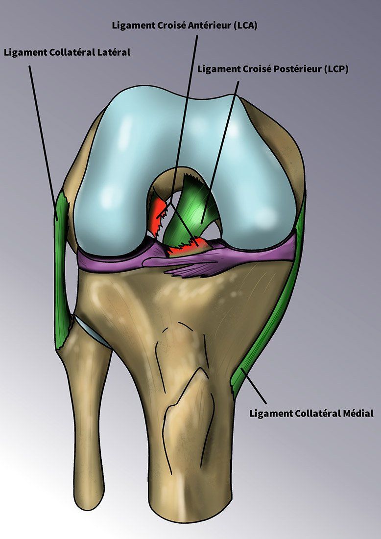 Schéma ligament croisé défaillant