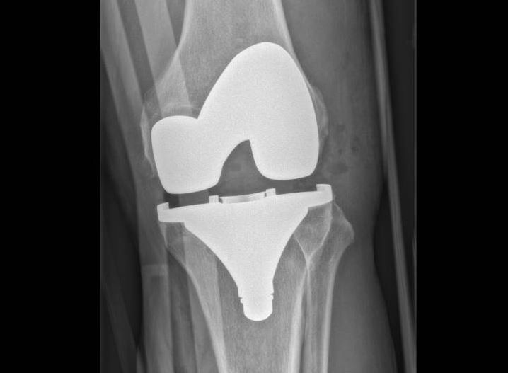 Radio - PROTHÈSES TOTALES DU GENOU