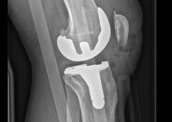 Radio 2 - PROTHÈSES TOTALES DU GENOU