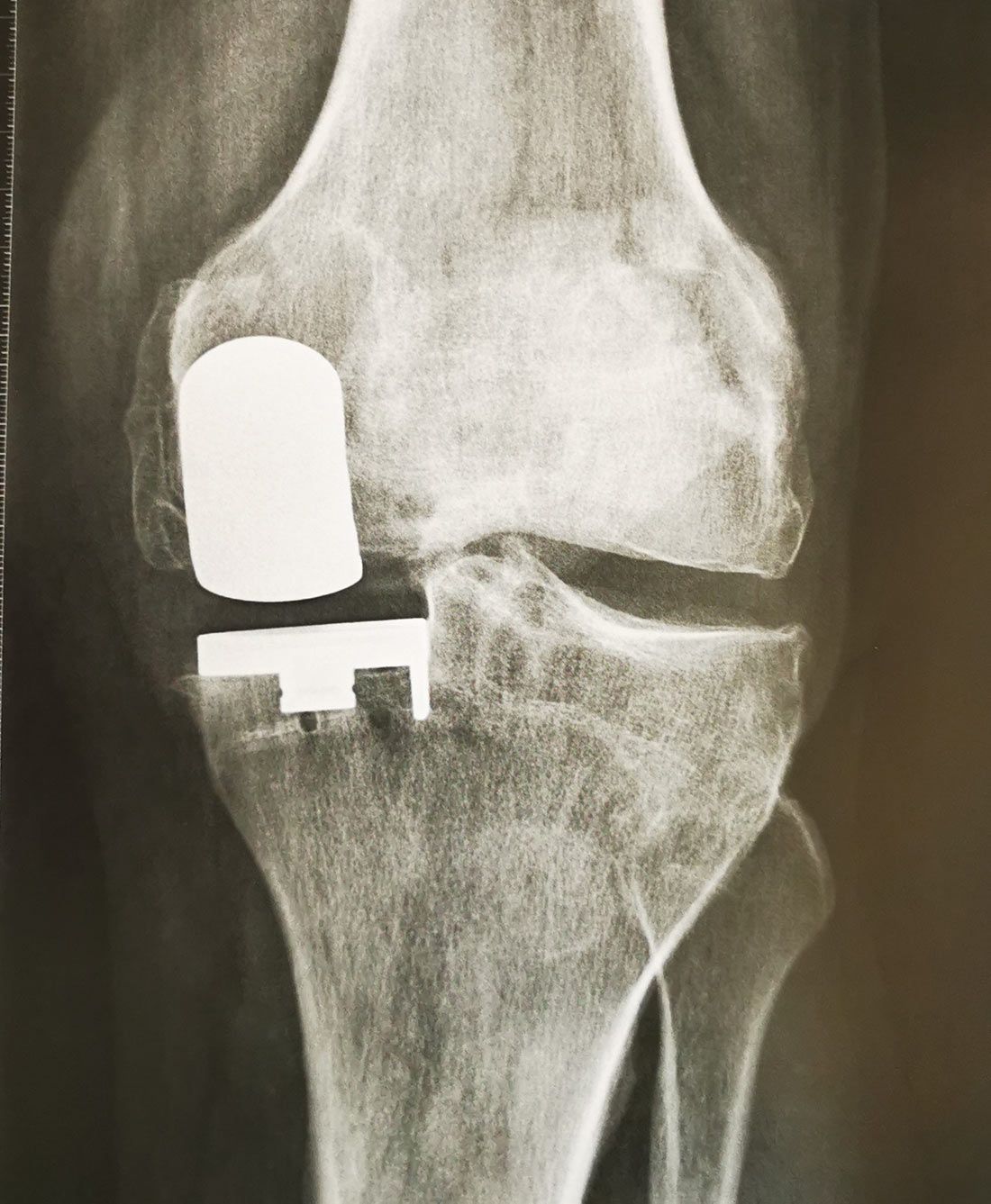 Radio - PROTHÈSES UNICOMPARTIMENTALES DU GENOU