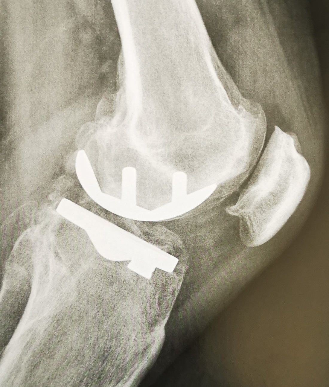 Radio 2 - PROTHÈSES UNICOMPARTIMENTALES DU GENOU