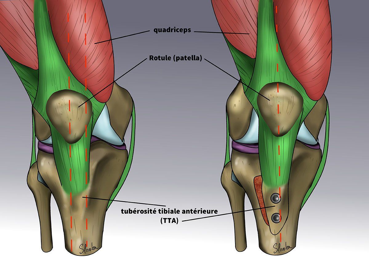 Illustration très détaillé - STABILISER LA PATELLA