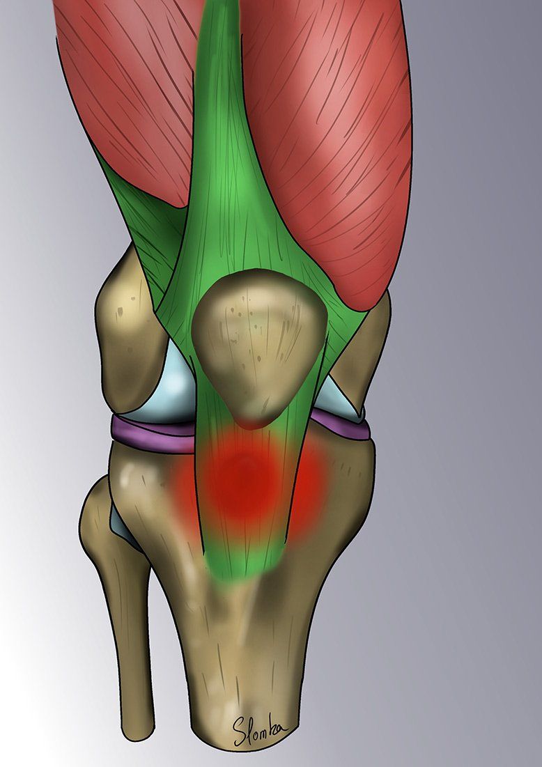 TENDINITE DU TENDON ROTULIEN