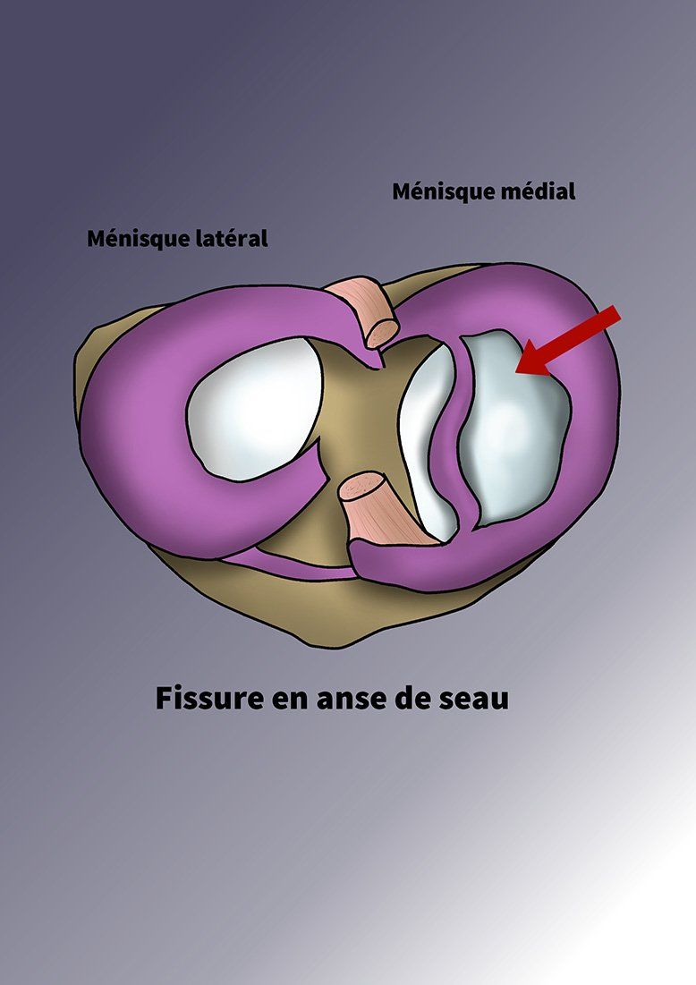 Illustration du ménisque (haut) par Dr Slomka