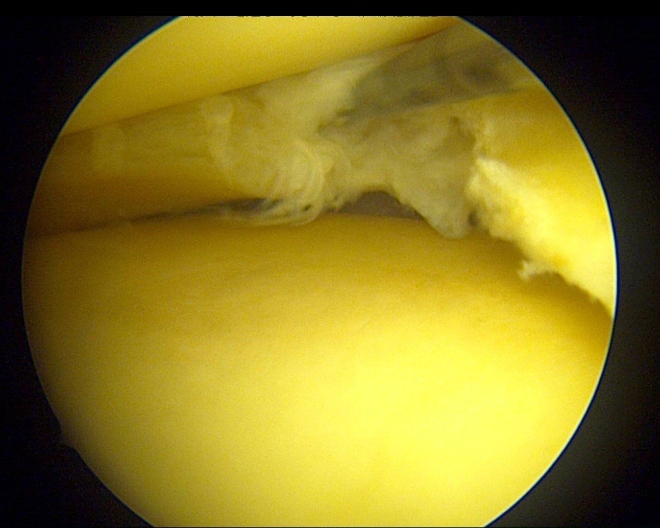 Arthro genou 3- fissure ménisque