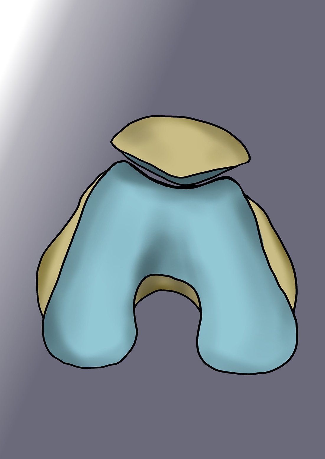 INSTABILITÉ DE LA PATELLA DROIT