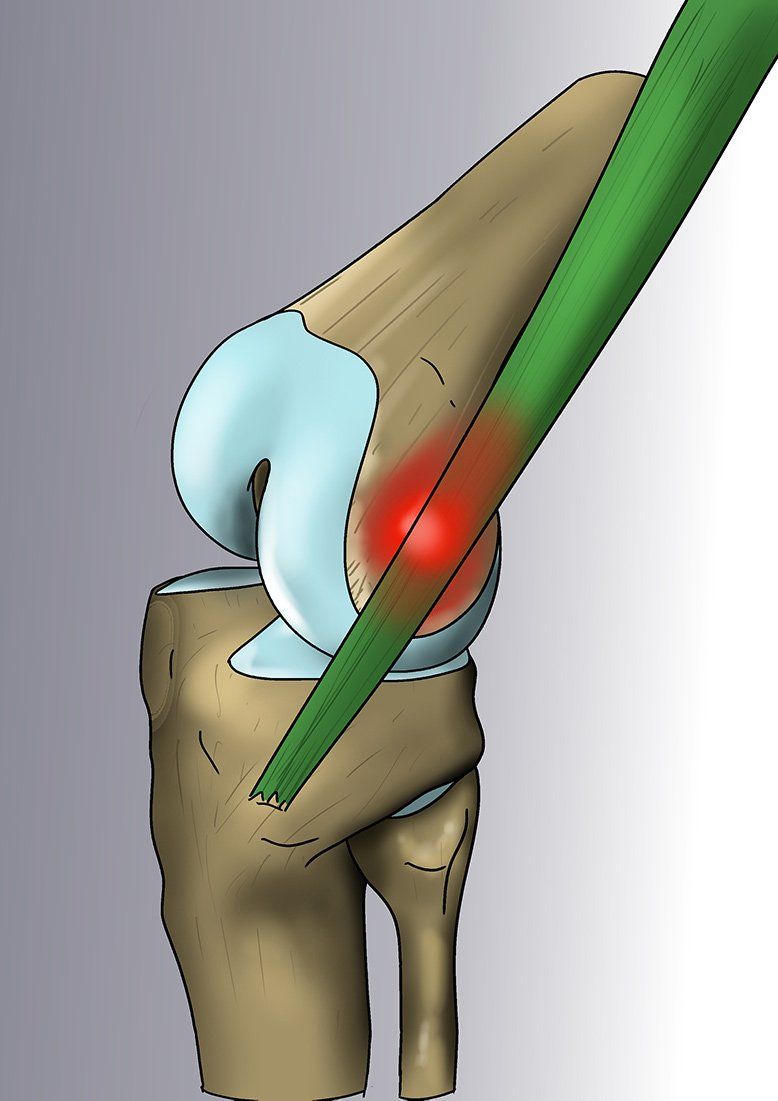 Illustration du SYNDROME DE L’ESSUIE-GLACE par Dr Slomka