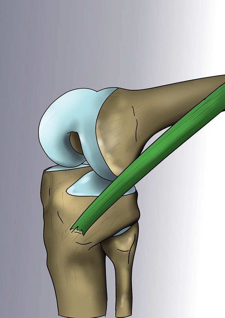 SYNDROME DE L’ESSUIE-GLACE Plier