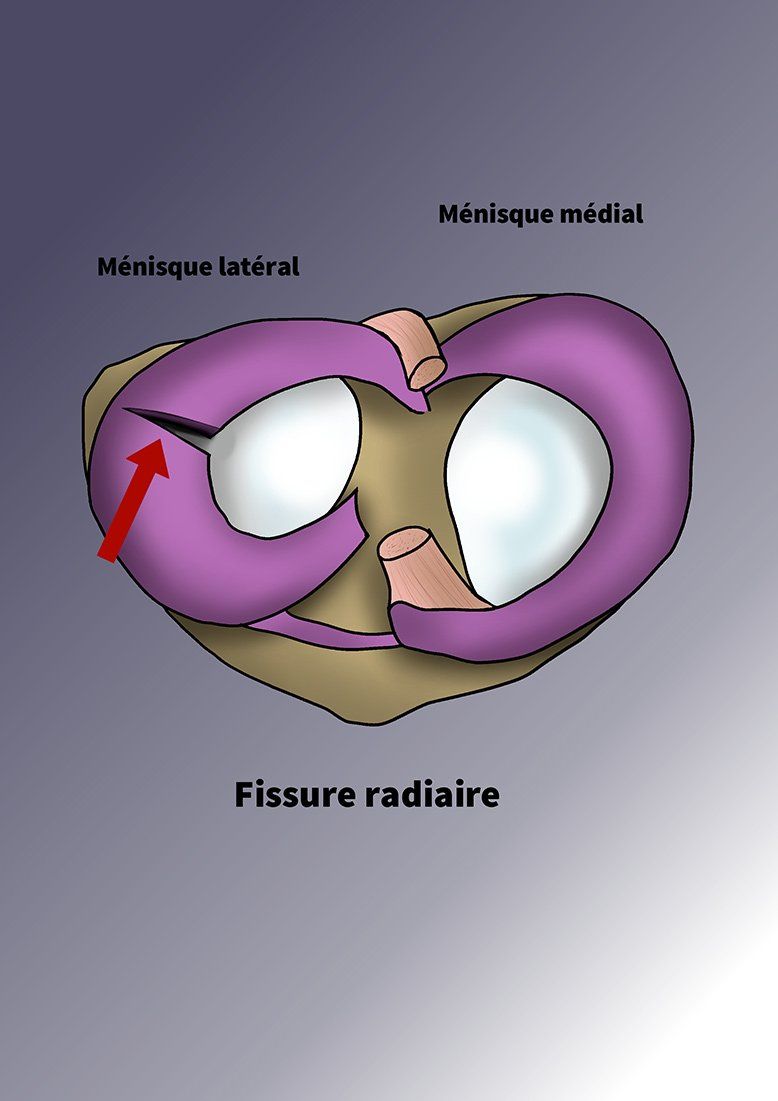 Illustration d'une fissure radiaire non réparée