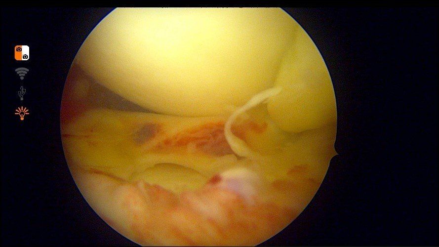 Vue arthroscopique : anse de seau du ménisque médial luxée en avant du genou