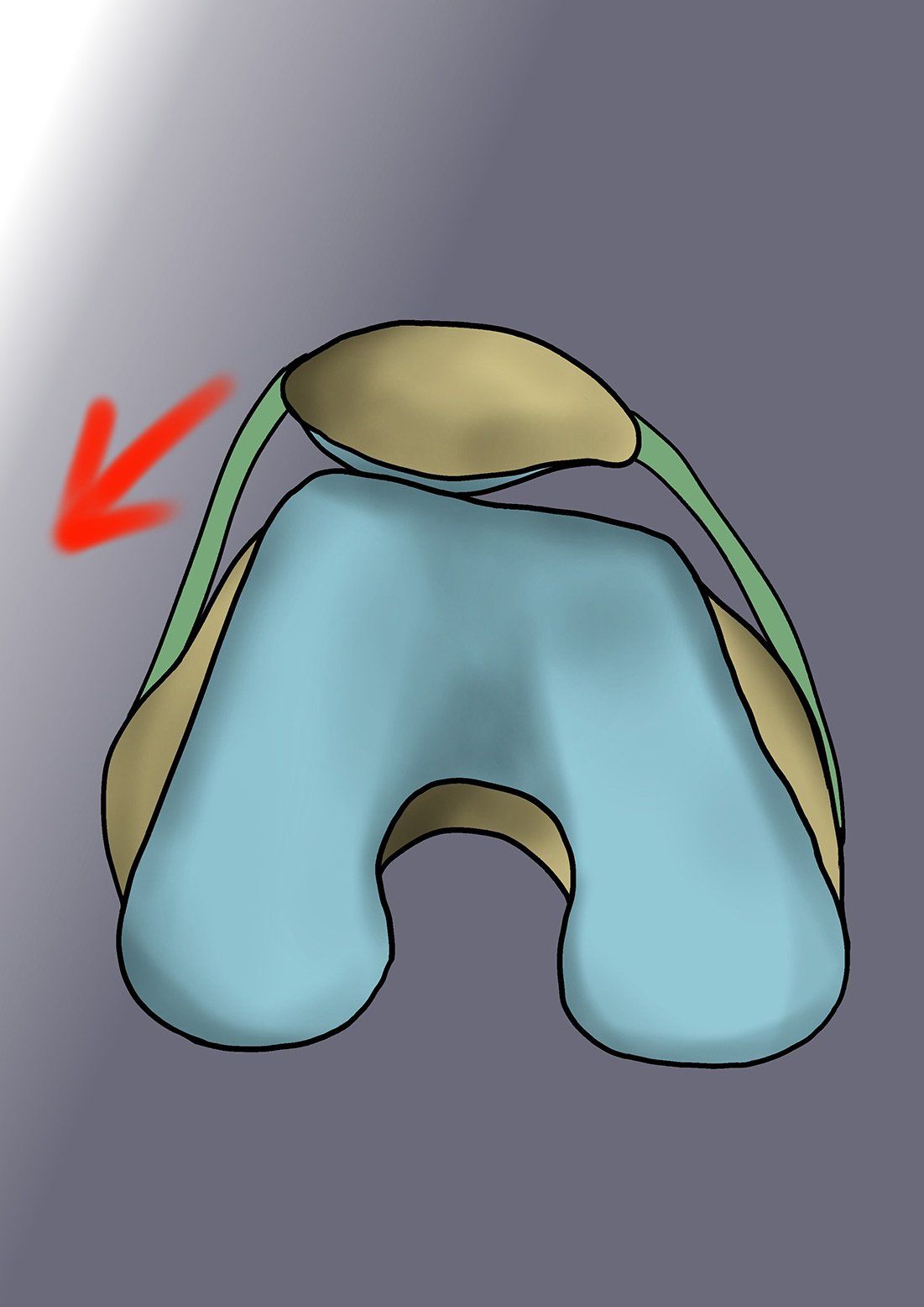 Ligament sain flèche sur la gauche