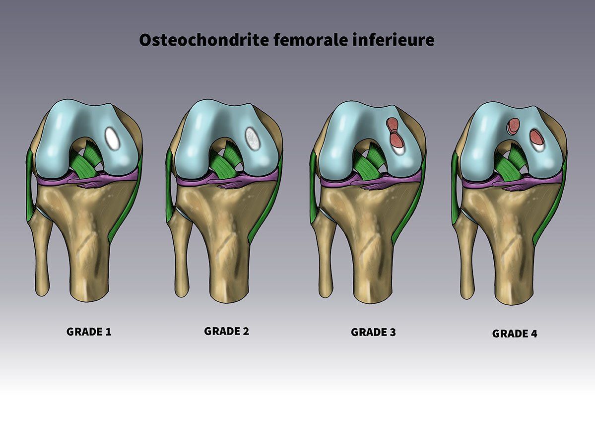 Illustration de ostéochondrite femoral inferieur illustré par Dr Slomka