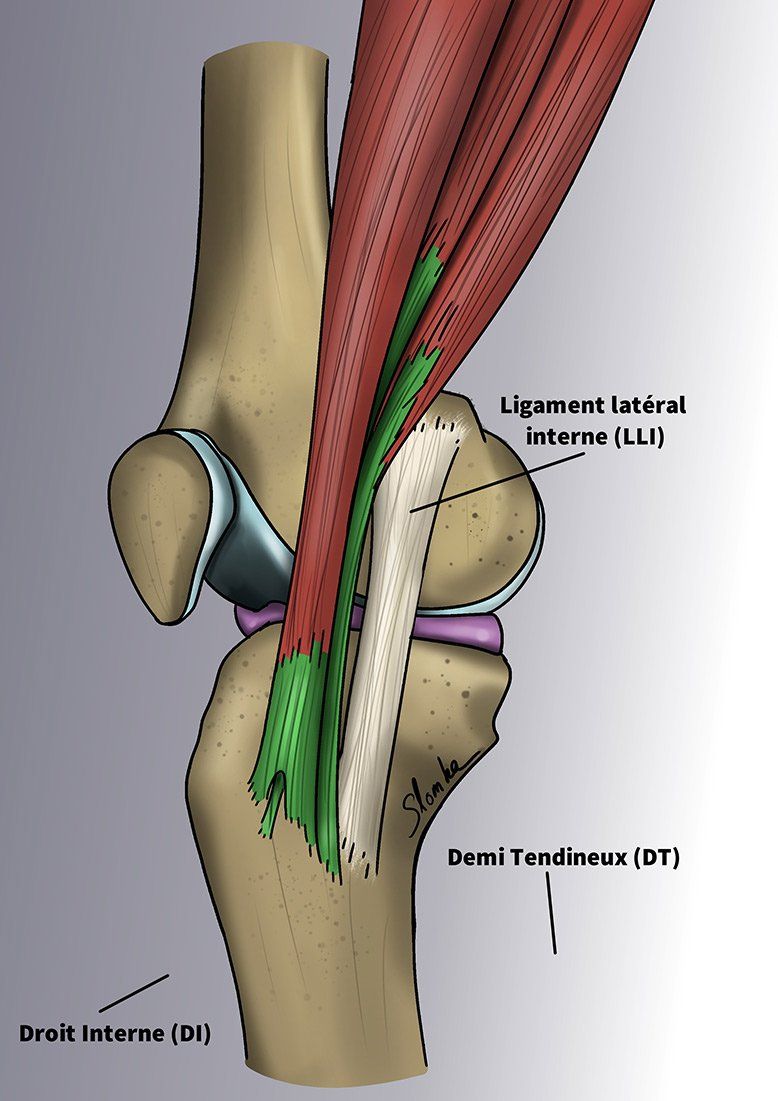illustration 2 TENDINITE DE LA PATTE D’OIE par Dr Slomka