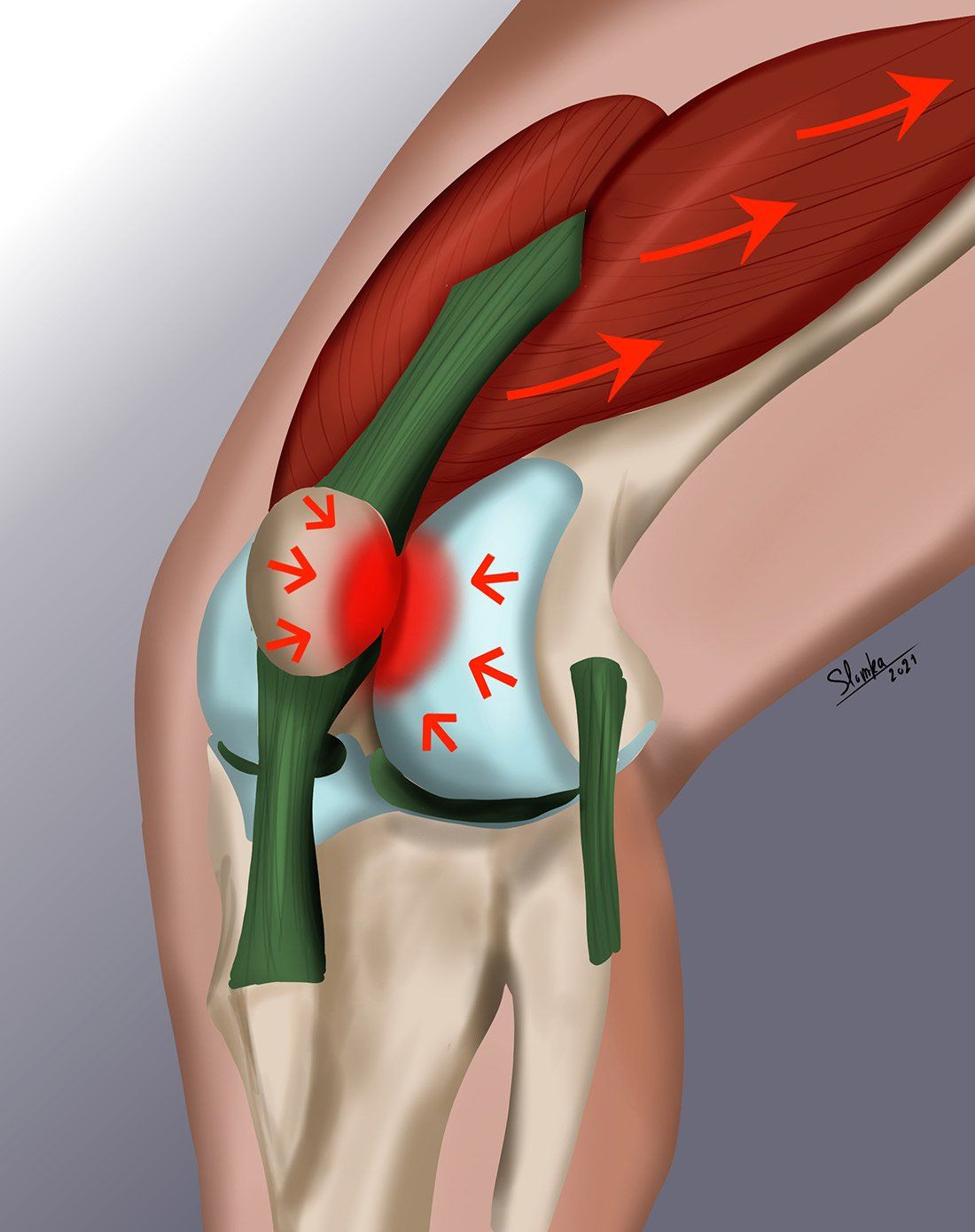 Illustration du SYNDROME ROTULIEN par Dr Slomka
