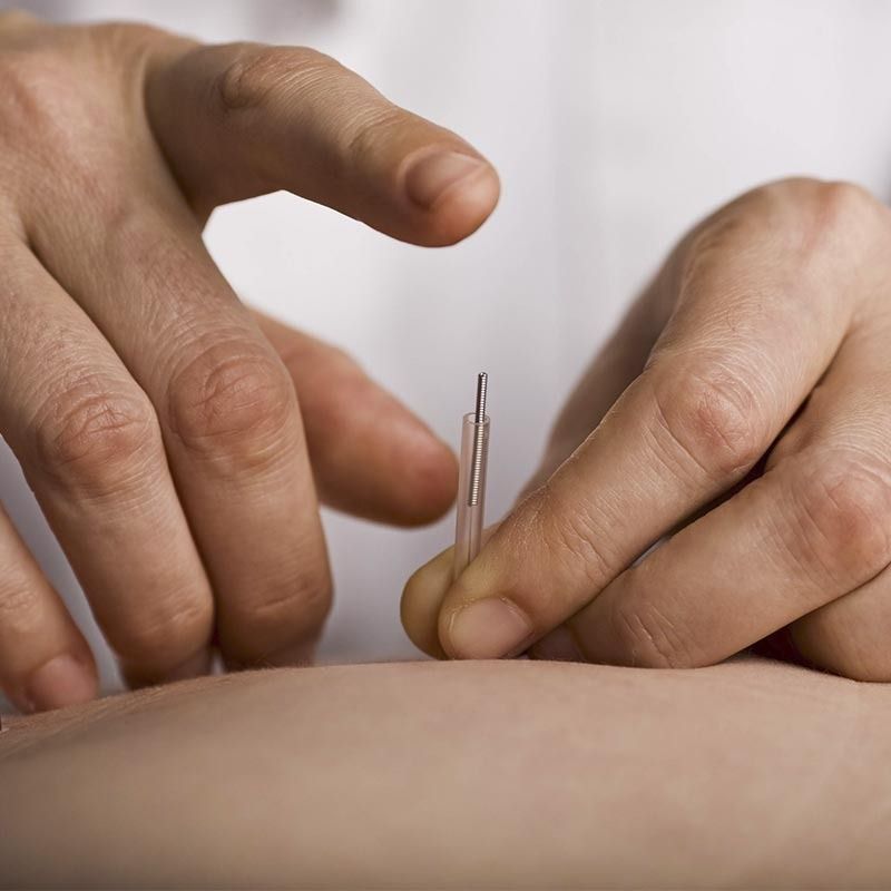 Una persona está aplicando agujas de acupuntura en el brazo de otra persona.