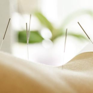 Una persona está recibiendo acupuntura en la espalda.
