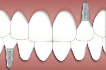 Ilustración de implantes dentales en la mandíbula superior, mostrando tornillos que reemplazan los dientes faltantes.