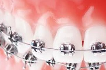 Primer plano de dientes con aparatos metálicos, mostrando brackets, alambres y encías en la boca.