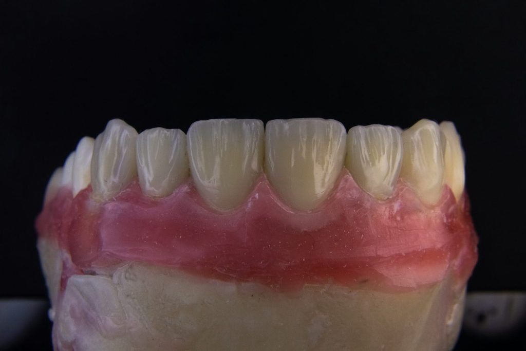 Dentaduras postizas sobre un molde, que muestran encías rosadas y dientes blancos, sobre un fondo negro.