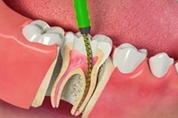 Diagrama de un diente sometido a tratamiento de conducto; hay un instrumento verde dentro del diente.
