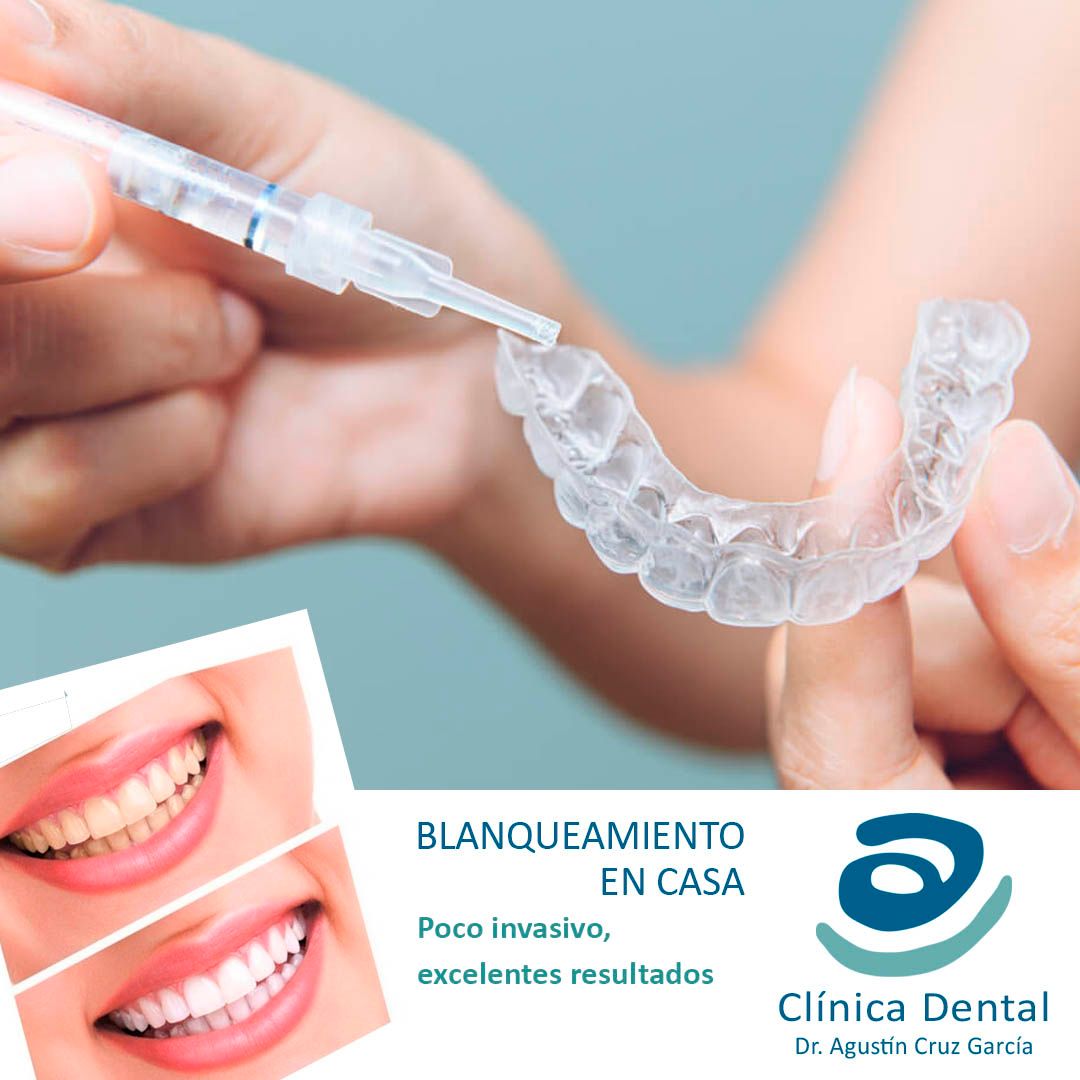 Imagen dividida de una sonrisa antes y después del blanqueamiento dental