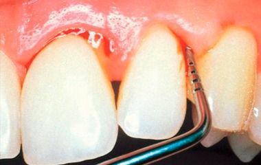 Sonda dental examinando la línea de las encías entre los dientes frontales con un ligero enrojecimiento de las encías.