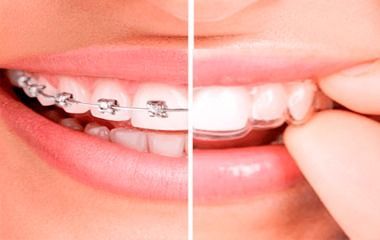 Imagen dividida de una sonrisa que muestra aparatos de ortodoncia en un lado y dientes blancos y rectos en el otro.