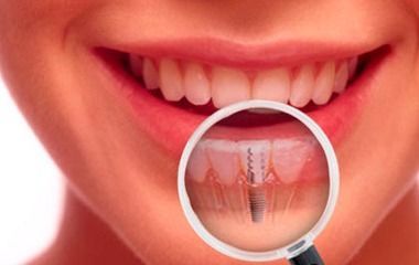 Primer plano de una boca sonriente con una lupa que resalta los dientes inferiores.