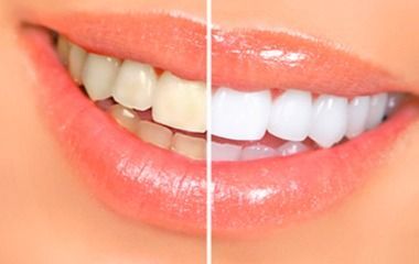 Imagen dividida de una sonrisa antes y después del blanqueamiento dental