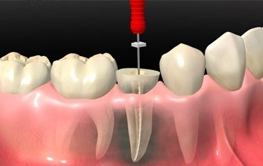 Taladro para implantes dentales insertando un poste en el alvéolo dental en encías rosadas.