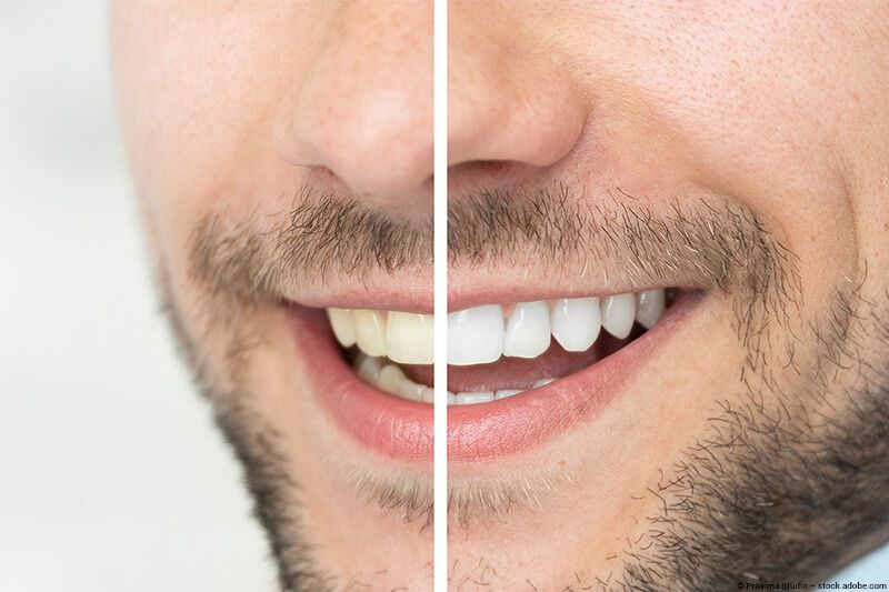 Lächelnder Patient im Vorher-Nachhervergleich beim Zahnbleaching in Frankfurt-Bornheim