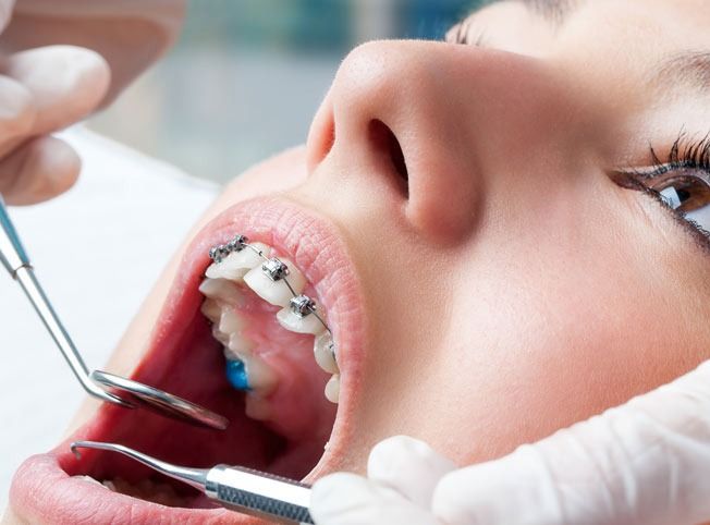 Una mujer con aparatos ortopédicos se hace examinar los dientes por un dentista.