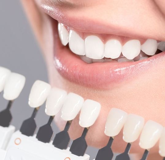 Un primer plano de los dientes de una mujer con una tabla de colores de dientes.