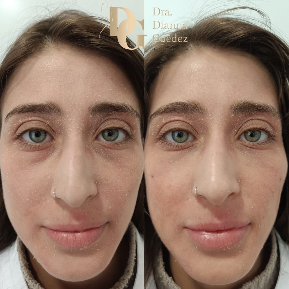 Comparación del rostro de una mujer antes y después del tratamiento, mostrando una reducción de las ojeras y una mejora en la textura de la piel.