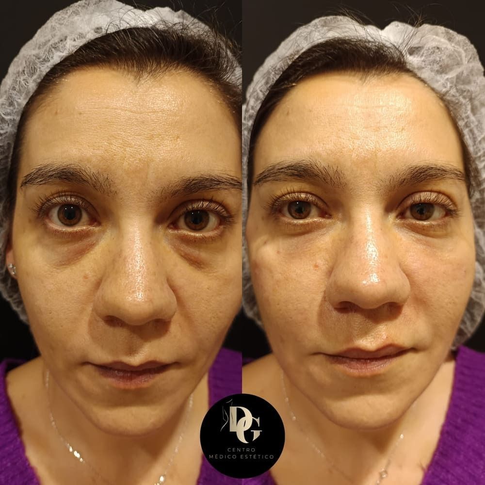 Comparación del antes y el después que muestra una reducción de las ojeras y las bolsas debajo de los ojos tras un tratamiento estético facial.
