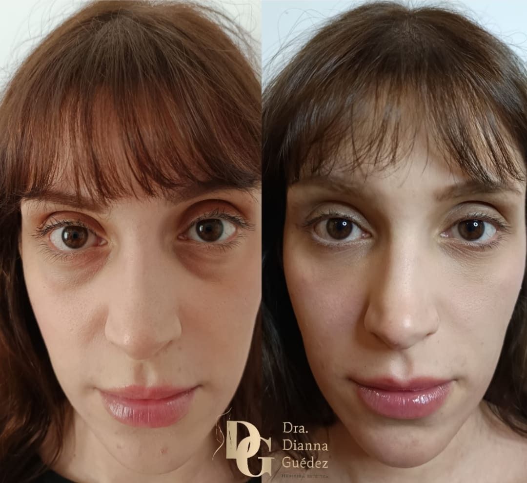 Comparación del antes y el después de la zona debajo de los ojos de una persona, que muestra una reducción de las ojeras y la hinchazón tras el tratamiento.