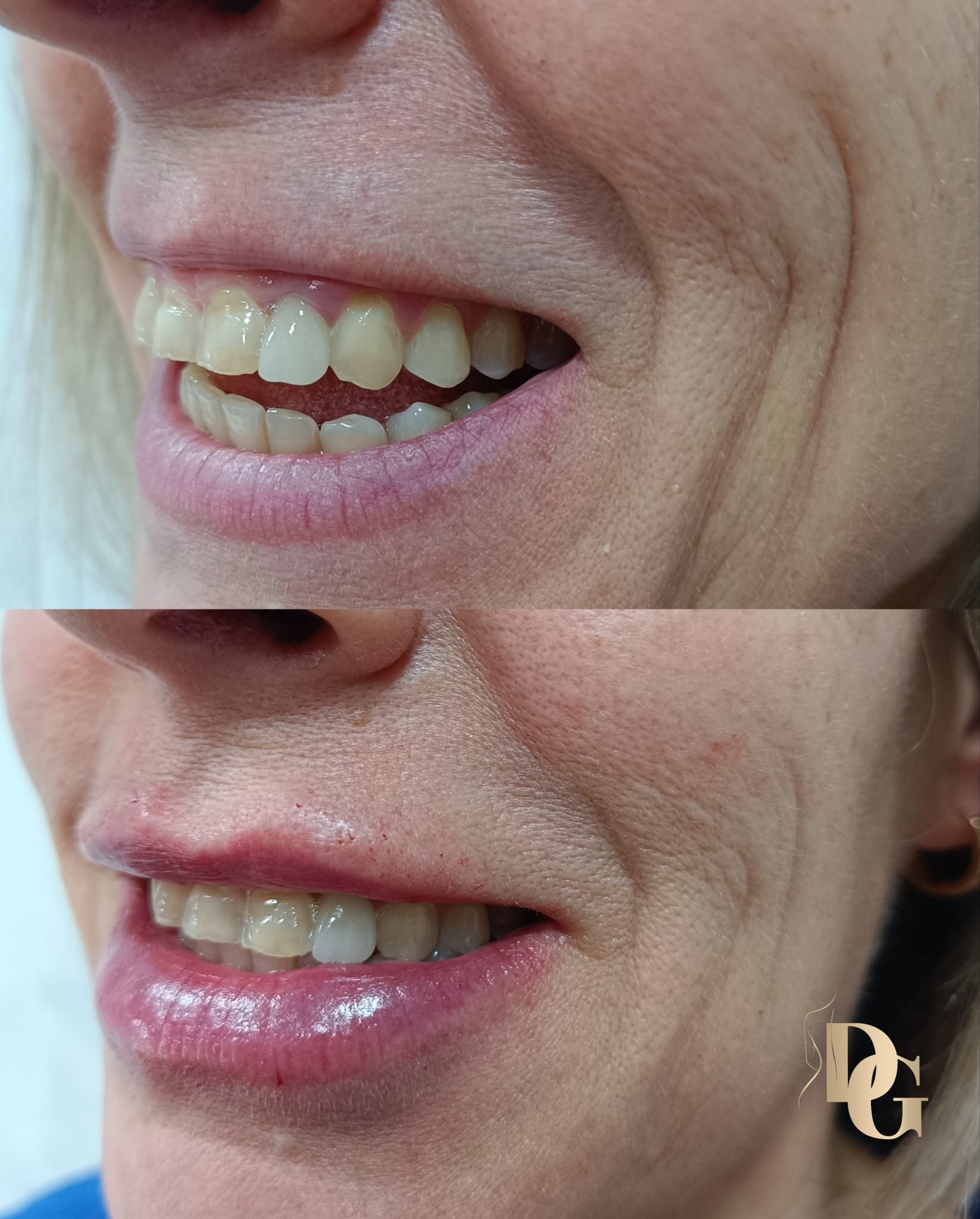 Comparación de los labios antes y después de un procedimiento de mejora estética.