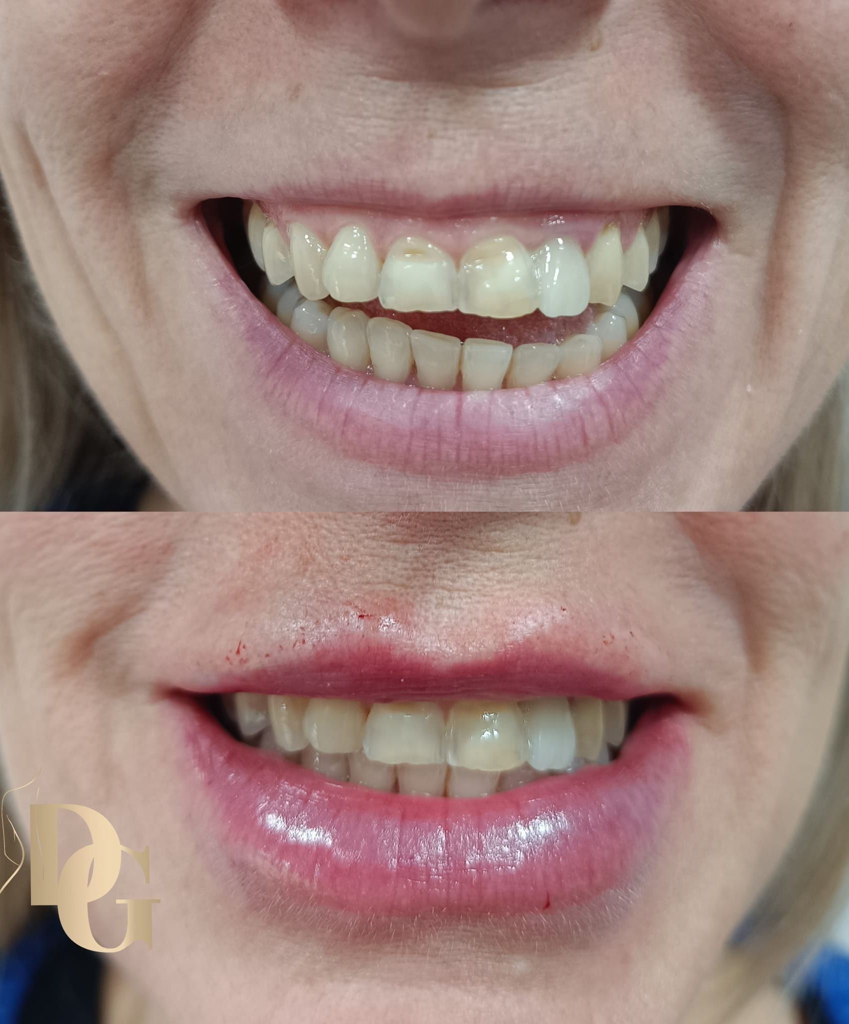 Comparación del antes y el después de una sonrisa que muestra una mejora dental y labios más voluminosos tras un procedimiento cosmético.