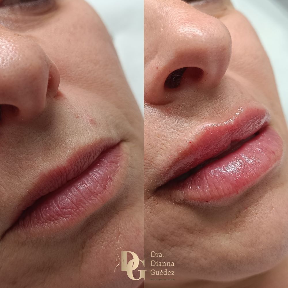 Una comparación del antes y el después que muestra los labios con una apariencia más voluminosa y definida tras un procedimiento cosmético.