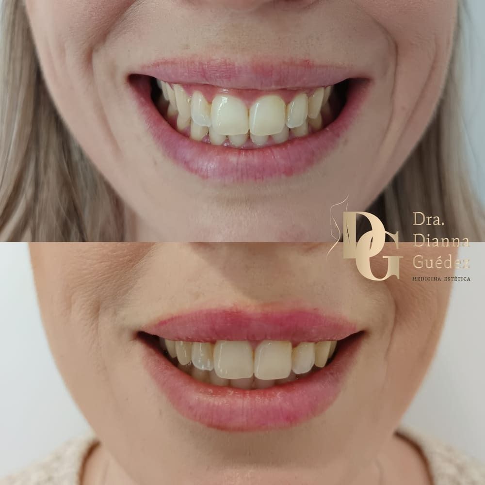 Comparación de una sonrisa antes y después de un procedimiento dental, mostrando una menor visibilidad de las encías.