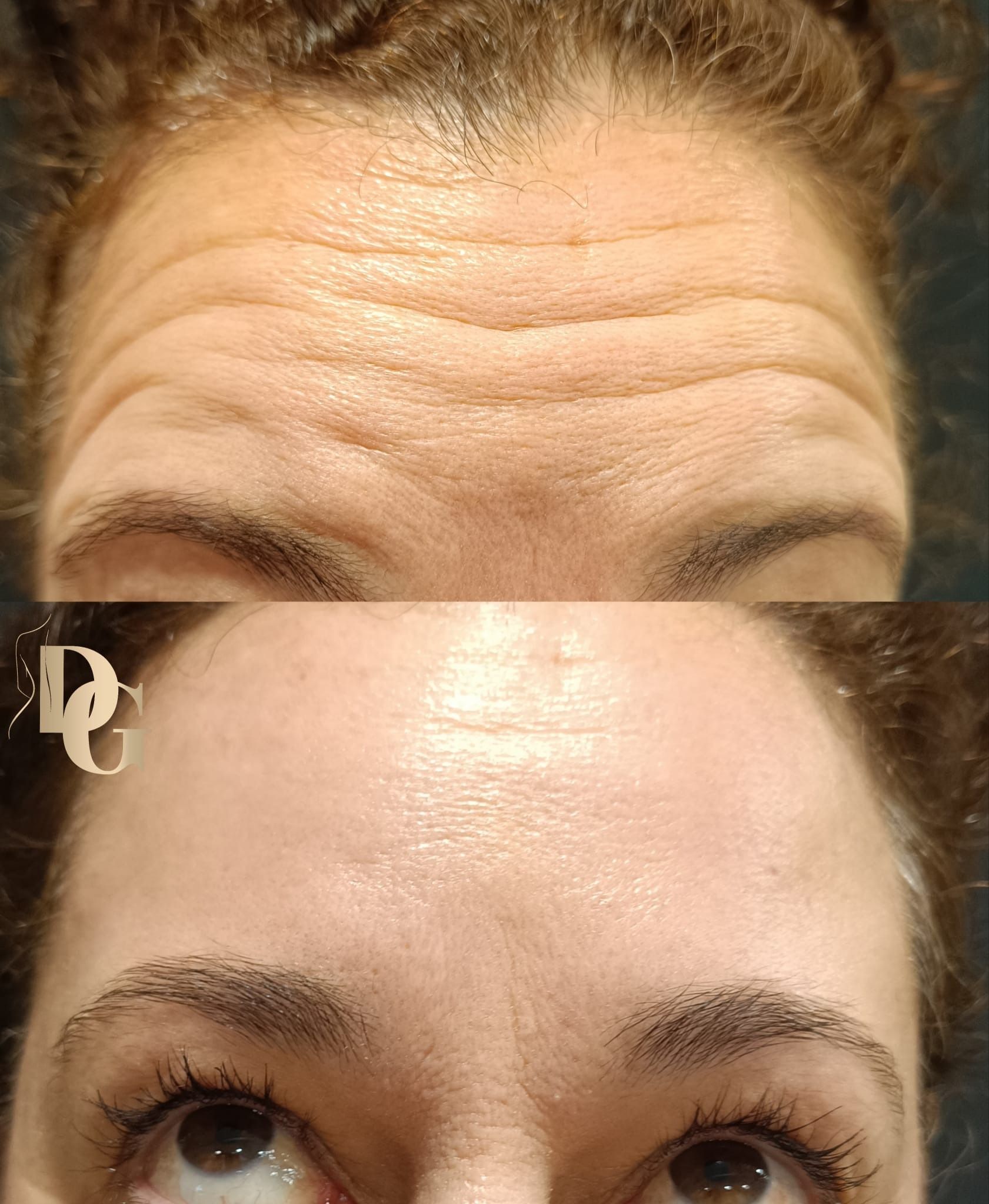 Comparación del antes y el después de una frente que muestra la reducción de las arrugas horizontales tras un procedimiento cosmético.