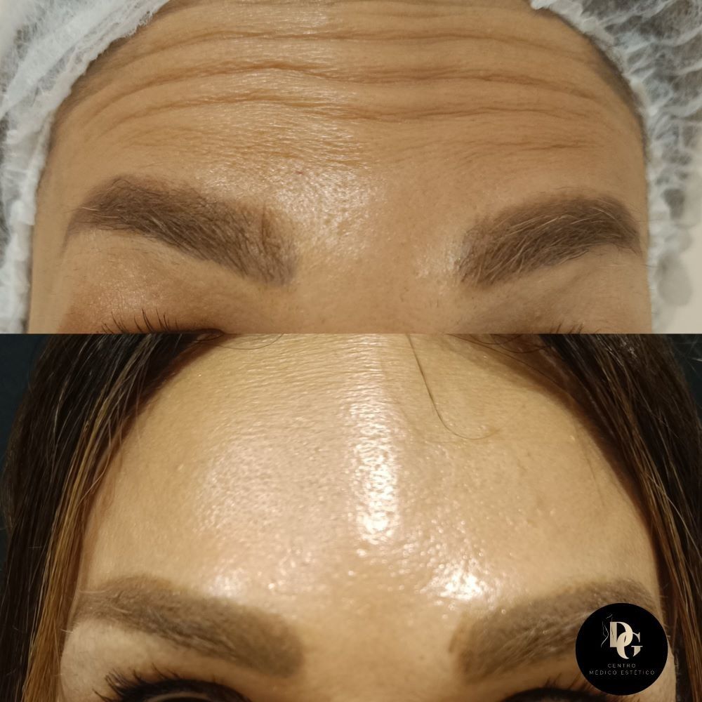 Comparación del antes y el después de una frente, que muestra una reducción significativa de las arrugas tras un tratamiento cosmético.