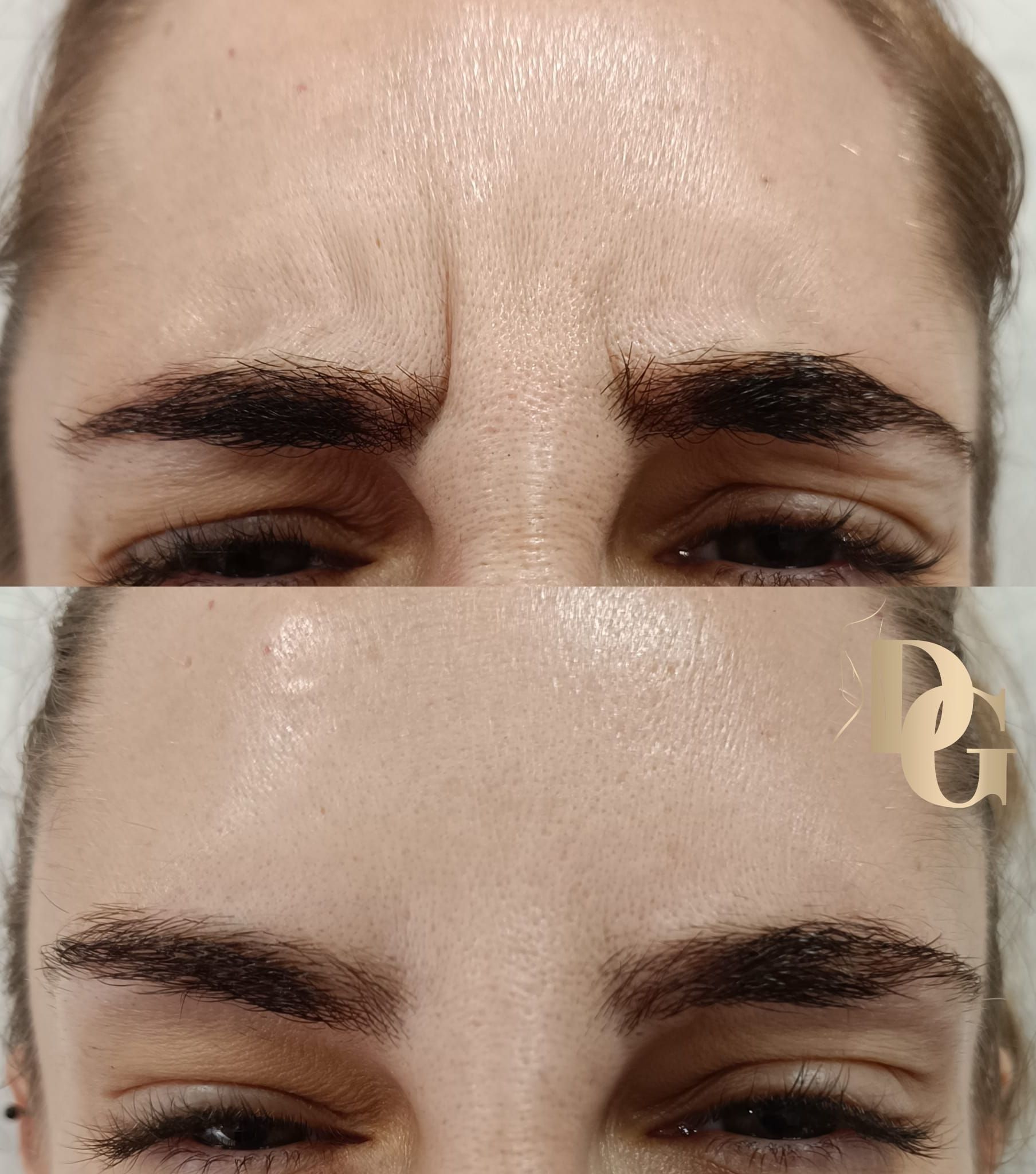 Imagen del antes y el después de una frente que muestra la reducción de las líneas de expresión del entrecejo tras un tratamiento cosmético.