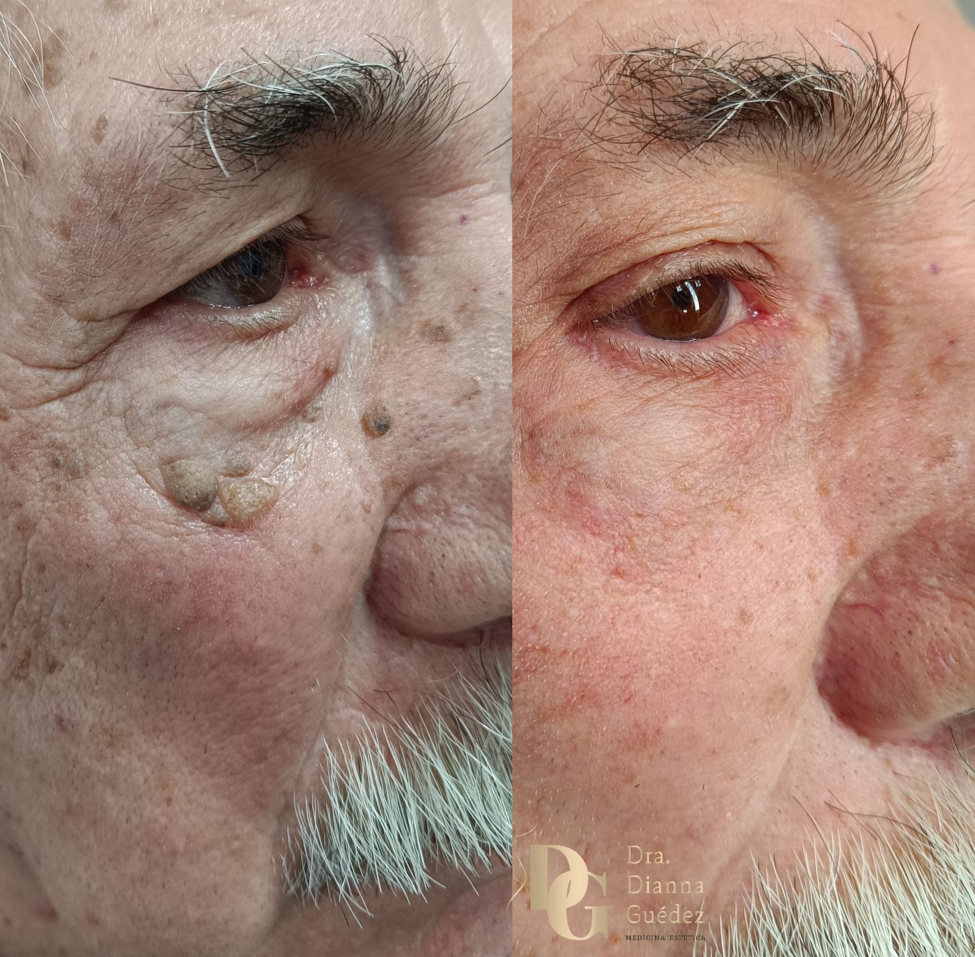 Comparación del antes y el después que muestra la eliminación exitosa de crecimientos cutáneos en el área debajo del ojo de una persona.