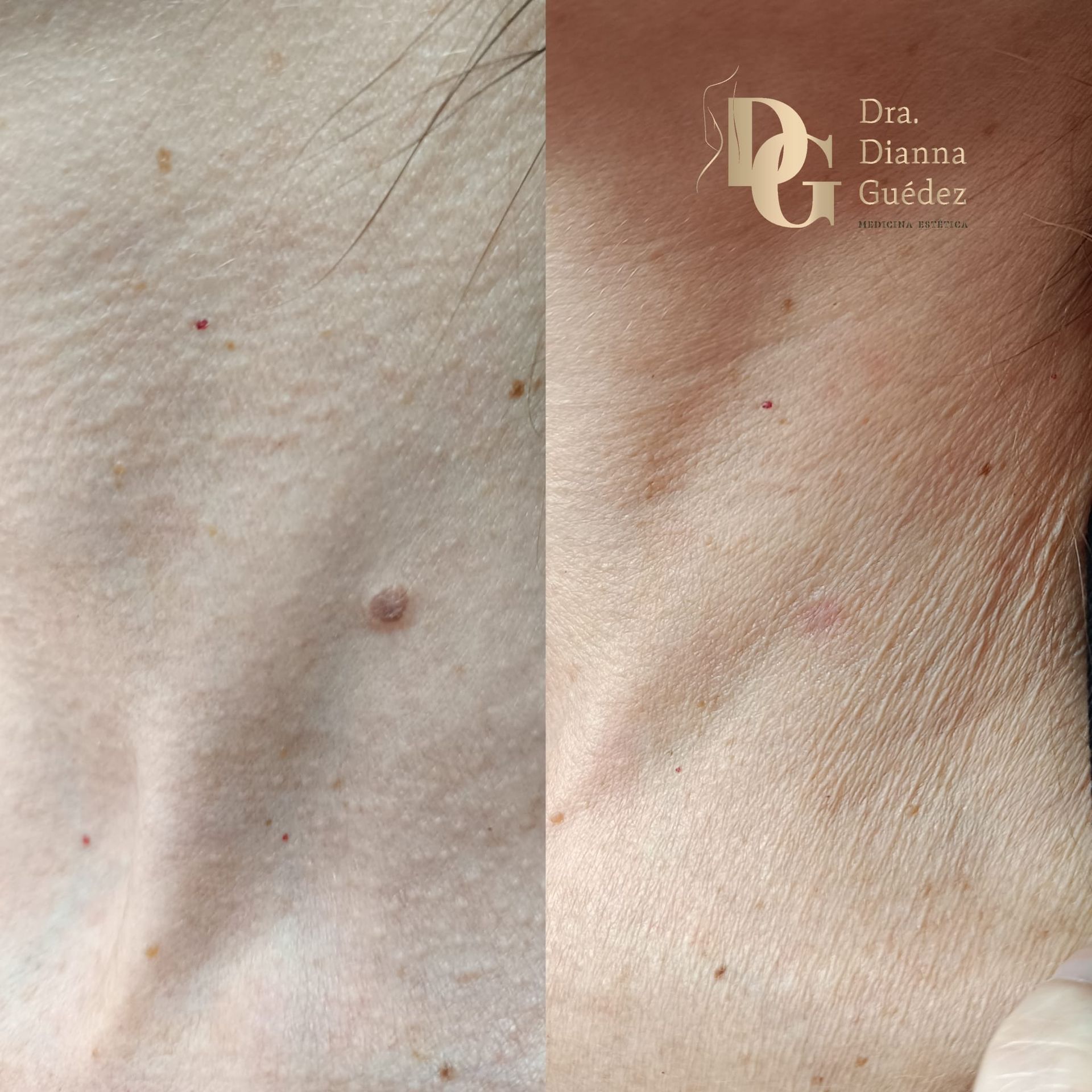 Imagen del antes y el después de un tratamiento cutáneo en el cuello, que muestra la eliminación de una pequeña lesión.