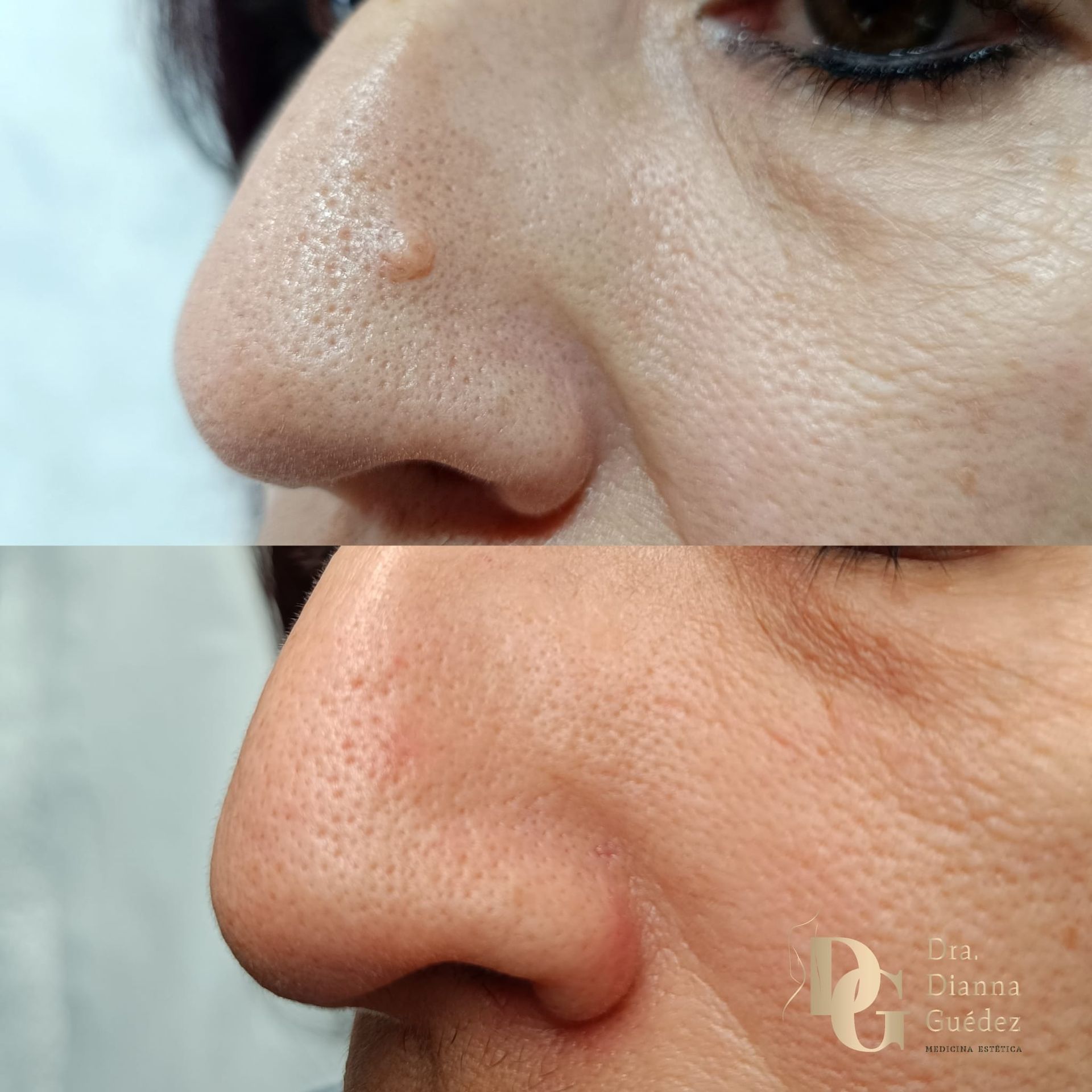 Fotografías del antes y el después que muestran la extirpación de un pequeño crecimiento cutáneo en el lateral de la nariz.