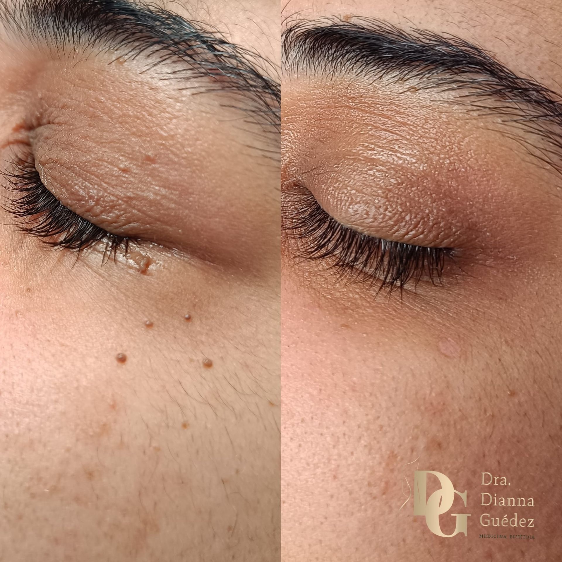 Comparación del antes y el después de un tratamiento cutáneo, que muestra la eliminación de pequeños bultos alrededor del ojo.