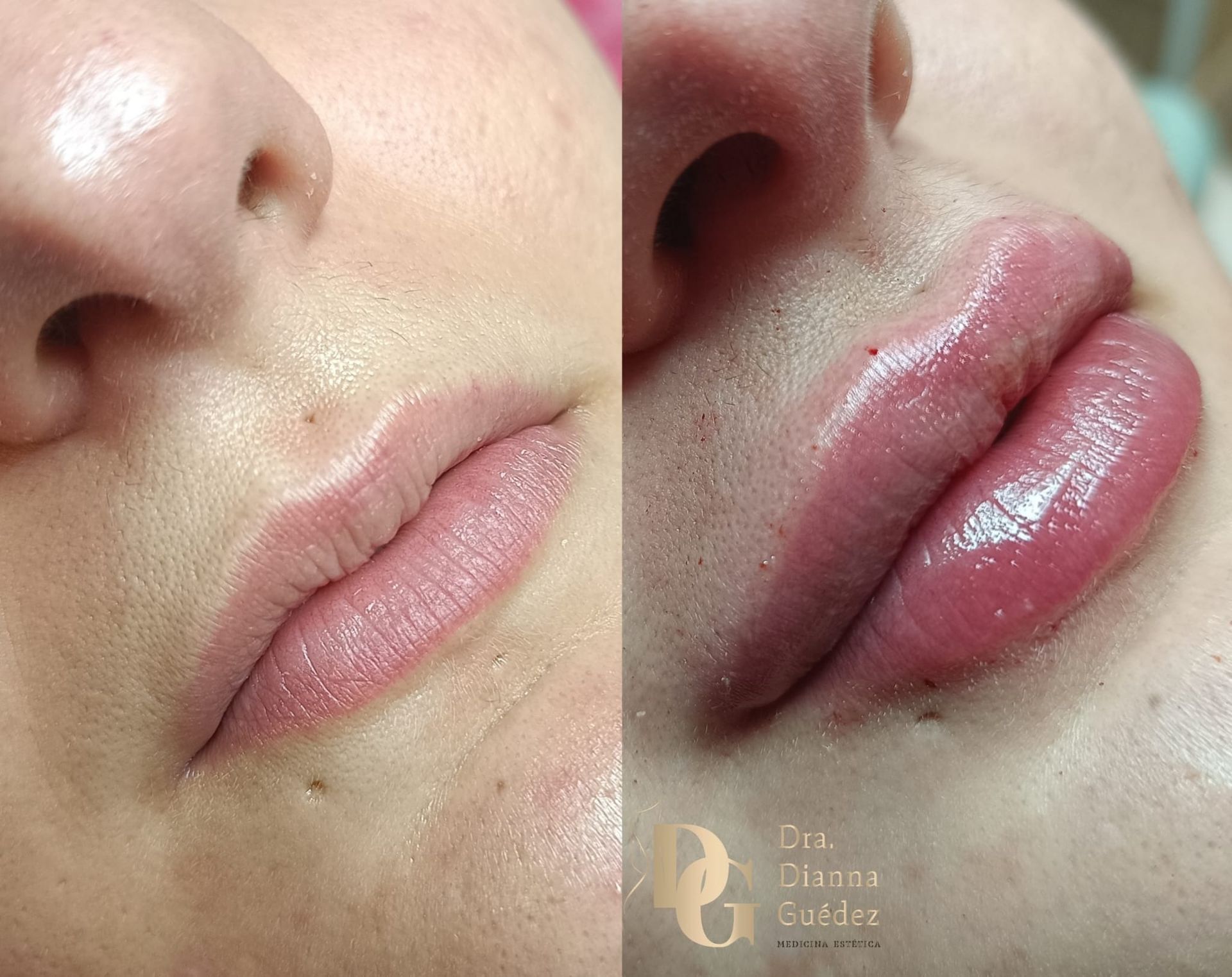 Comparación del antes y el después del tratamiento de relleno de labios, que muestra un aumento en el volumen de los labios y un sutil tono rosado.
